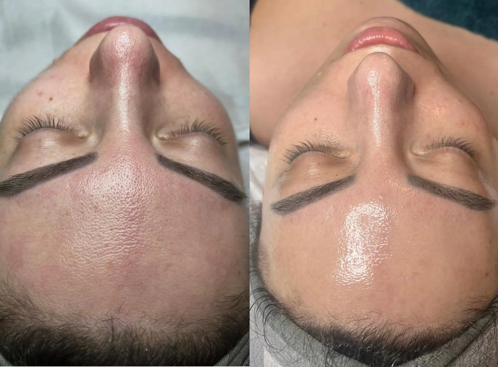 Queen City Project | What Should You Avoid After a Carbon Laser Peel? Common mistakes to avoid after your peel