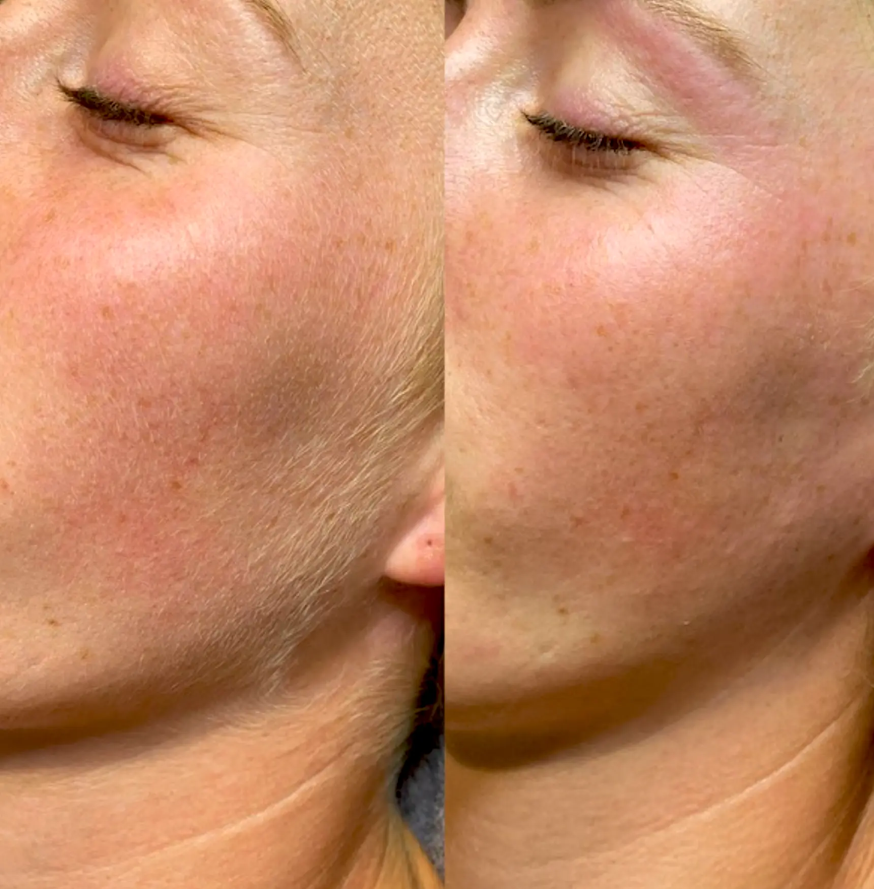 Do and don’ts of dermaplaning?