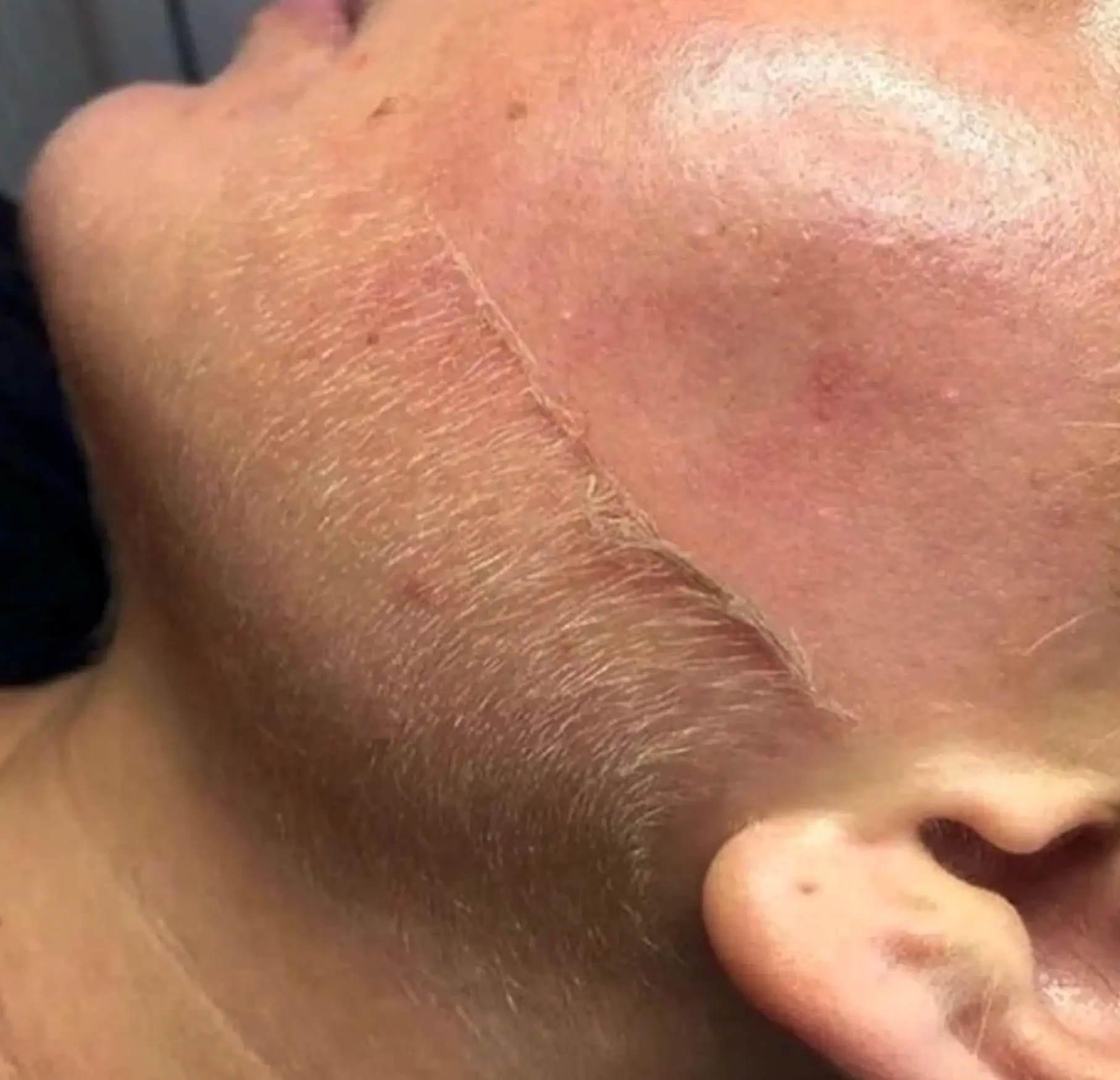 Queen City Project | Do and don'ts of dermaplaning? Don’t Use on Active Acne or Broken Skin