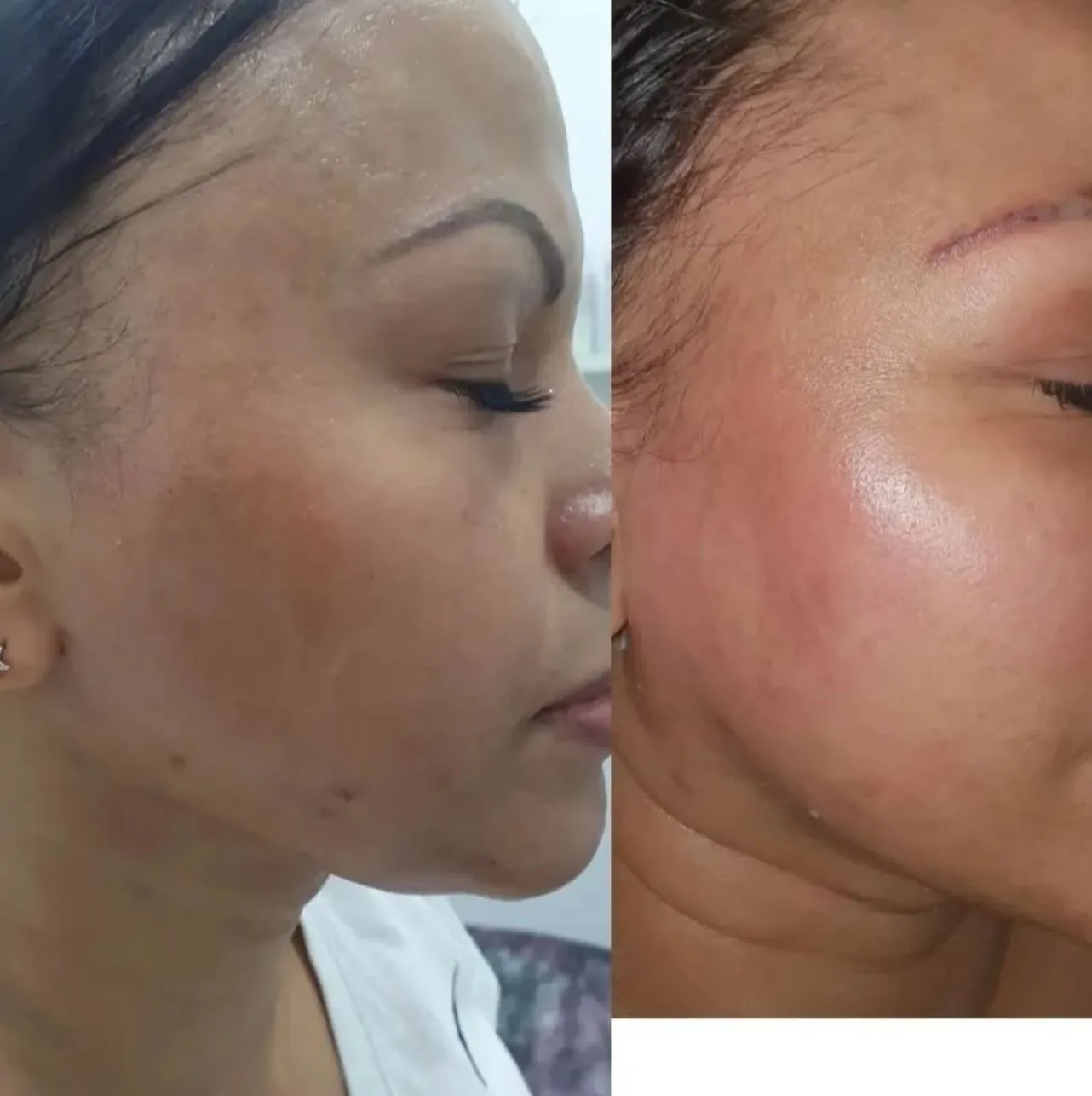 Queen City Project | What Should You Avoid After a Carbon Laser Peel? Healing timeline