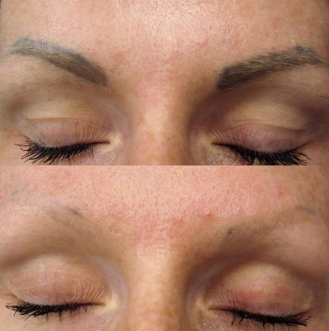Queen City Project | How Do You Remove Fresh Microblading? Laser Tattoo Removal