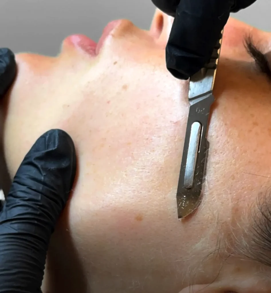 Queen City Project | Do and don'ts of dermaplaning? Ready to Try Dermaplaning