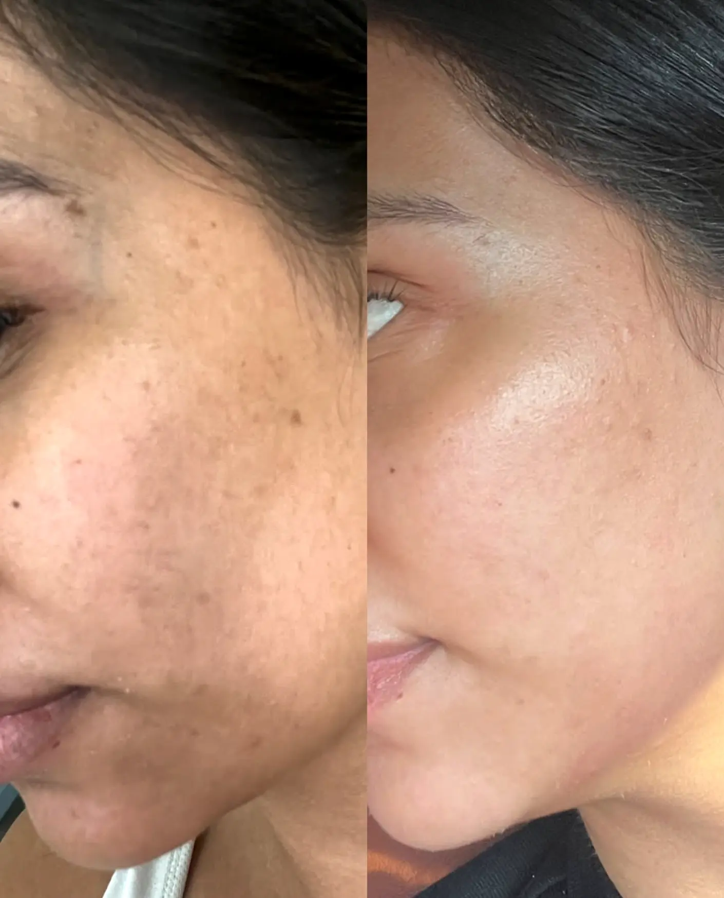 Queen City Project | Do and don'ts of dermaplaning? What Is Dermaplaning