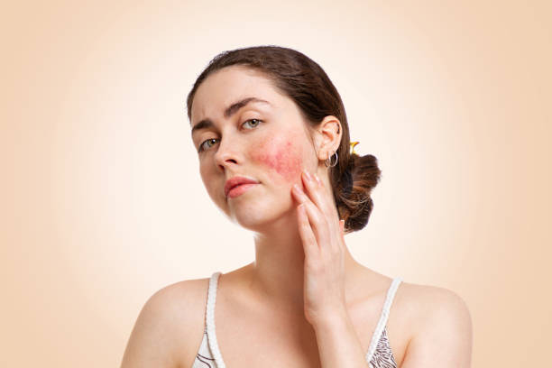 young woman examining her facial skin with visible redness and irritation